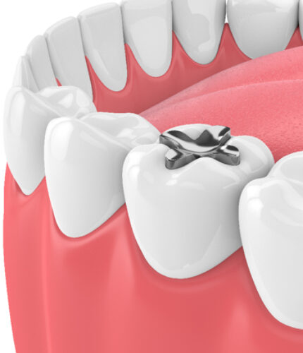 Treatment - 2 Green Dental Boutique