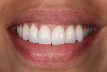 After - 2 Green Dental Boutique