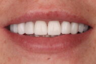 After - 2 Green Dental Boutique
