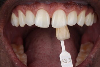 After - 2 Green Dental Boutique