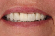 After - 2 Green Dental Boutique