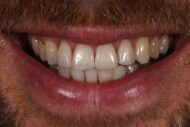 After - 2 Green Dental Boutique