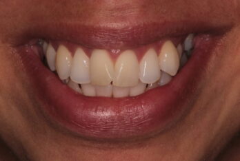 Before - 2 Green Dental Boutique