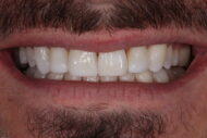 After - 2 Green Dental Boutique