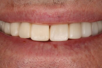 After - 2 Green Dental Boutique