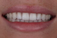 After - 2 Green Dental Boutique