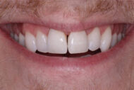 After - 2 Green Dental Boutique